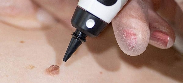 After Skin Tag Removal Horsham