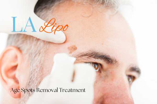 What Are the Most Effective Treatments for Age Spots Horsham?