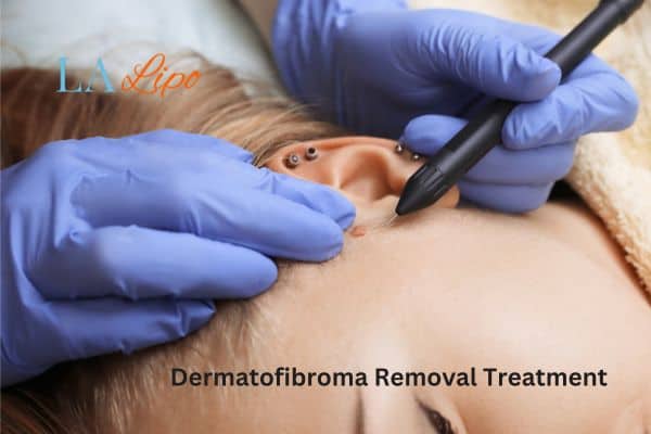 Dermatofibroma Removal Treatment Horsham