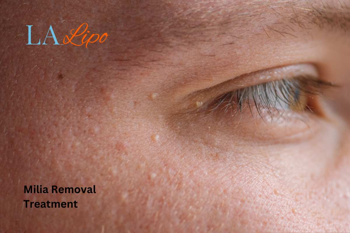 Cryopen Milia Removal: Is It the Easiest and Safest Option Horsham?
