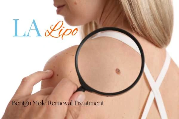 Why getting moles removed Horsham can boost your confidence!