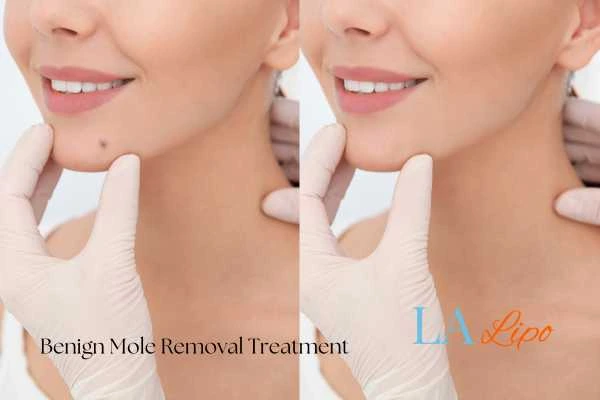 woman's before and after mole removal Horsham results