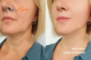 hi-fu for wrinkles Horsham before and after results