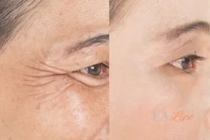 Before and after results of woman - HI-fu wrinkles reduction treatment Horsham
