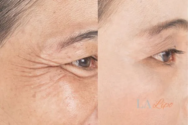Before and after results of woman - HI-fu wrinkles reduction treatment Horsham