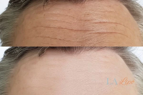 results of HIFU Horsham on mans forehead to help reduce lines and wrinkles