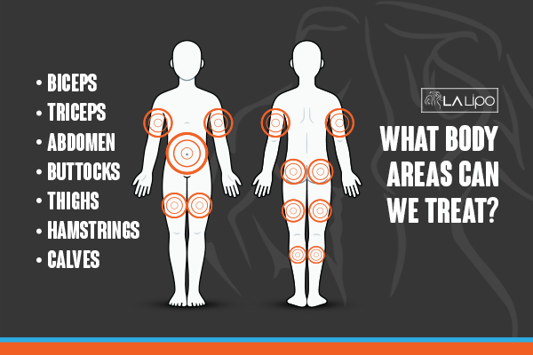 Graphic to show areas you can have LA-EMS Body Sculpting Horsham treatment.