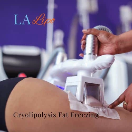 fat freezing - Cryolipolysis Horsham