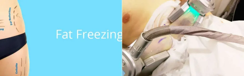Fat freezing Horsham on multiple areas of the body