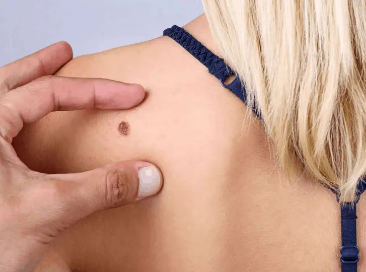 woman having mole removal Horsham consultation before treatment.