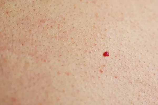 close up of a cherry angioma Horsham