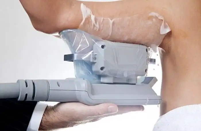 Picture of fat freezing Horsham on the upper arms.