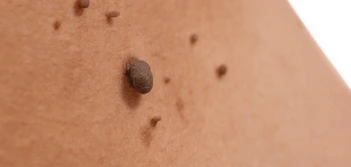 image of a skin tag Horsham