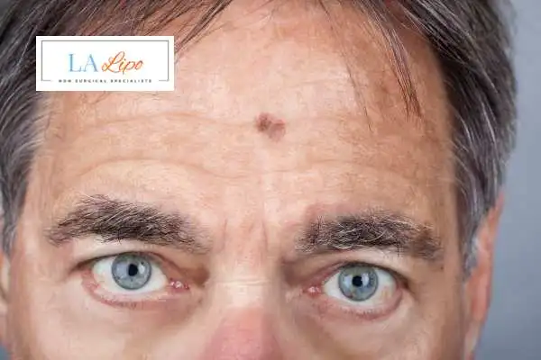 Solar Lentigo Removal Horsham image of man with mark on his forehead