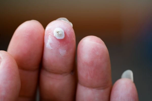 wart on person finger - cryotherapy to treat from LA LIPO Horsham