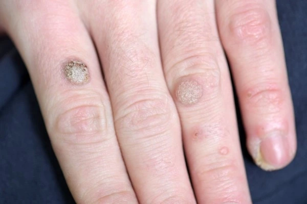 photo of warts on person hand - see wart removal Horsham from LA LIPO