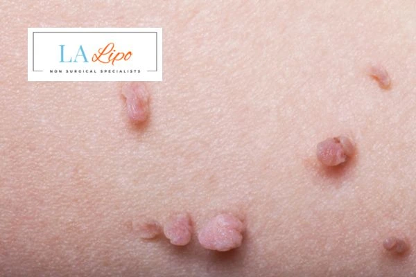 Does cryopen skin tag removal Horsham hurt? Find out now call our team today!