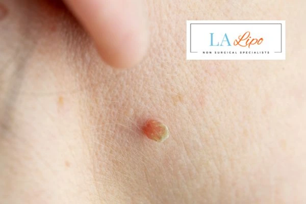 Book skin tag removal Horsham today speak to our team now!
