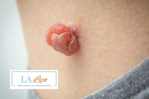 Interested in skin tag removal Horsham? Concerned about the pain? Find out more today!