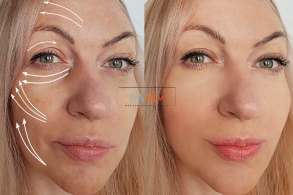 Morpheus 8 results Horsham face lift.