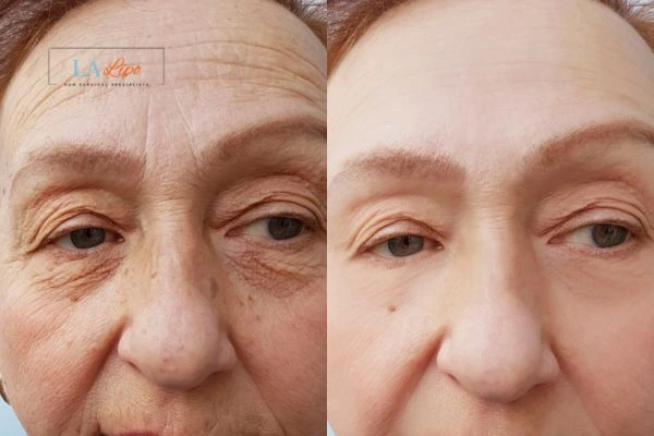 The powerful benefits of Morpheus8 Treatment Horsham - Call Our team today!