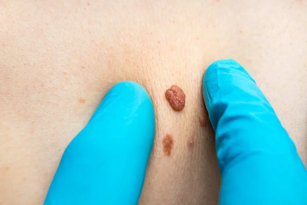 LA LIPO Cryopen Lesion Removal Prices Horsham