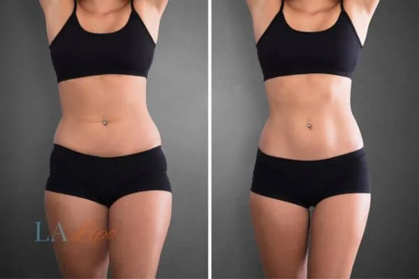before and after results of non-surgical treatment to help a woman's body image and mental health Horsham