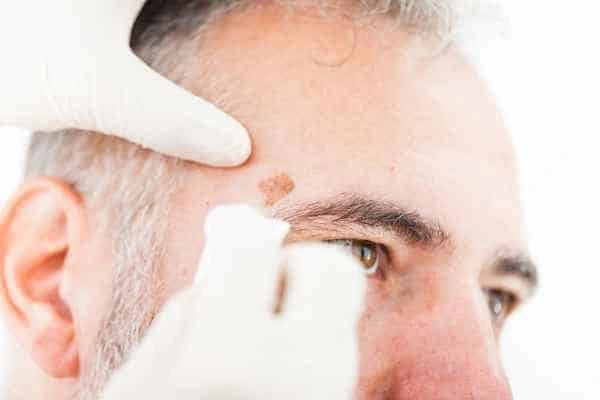 Age spots and elderly people Horsham what is the link?