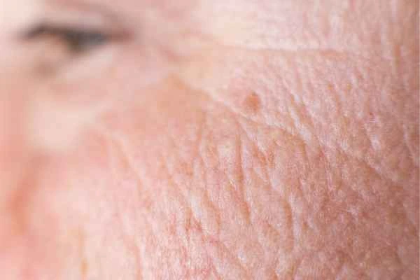 close up picture of a woman's face showing an age spot Horsham