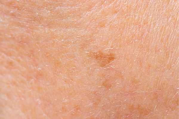 close up picture of age spots Horsham