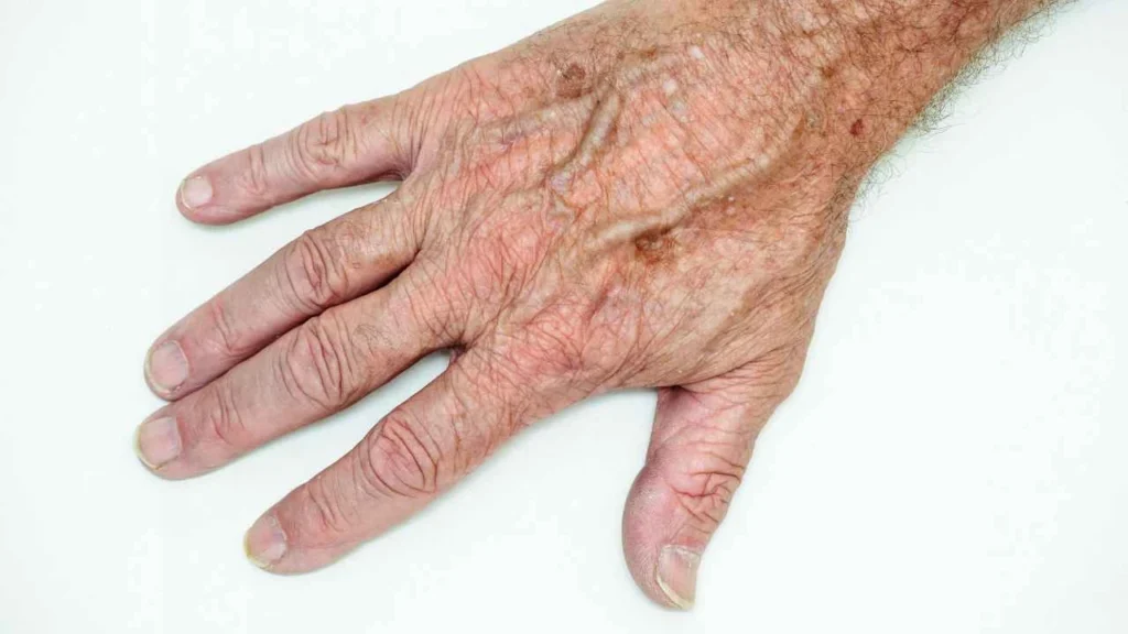 Male hand showing age spot Horsham