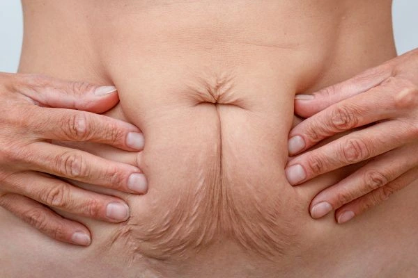 Image of a woman's stomach with loose skin - example of skin tightening Horsham options